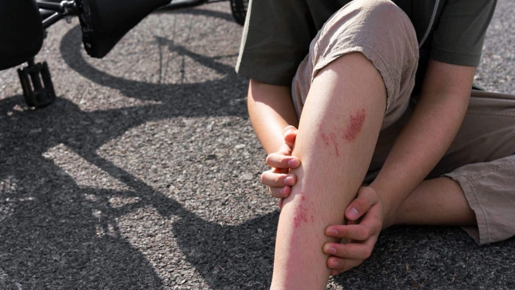 Road Rash From a Motorcycle Accident Lawyer