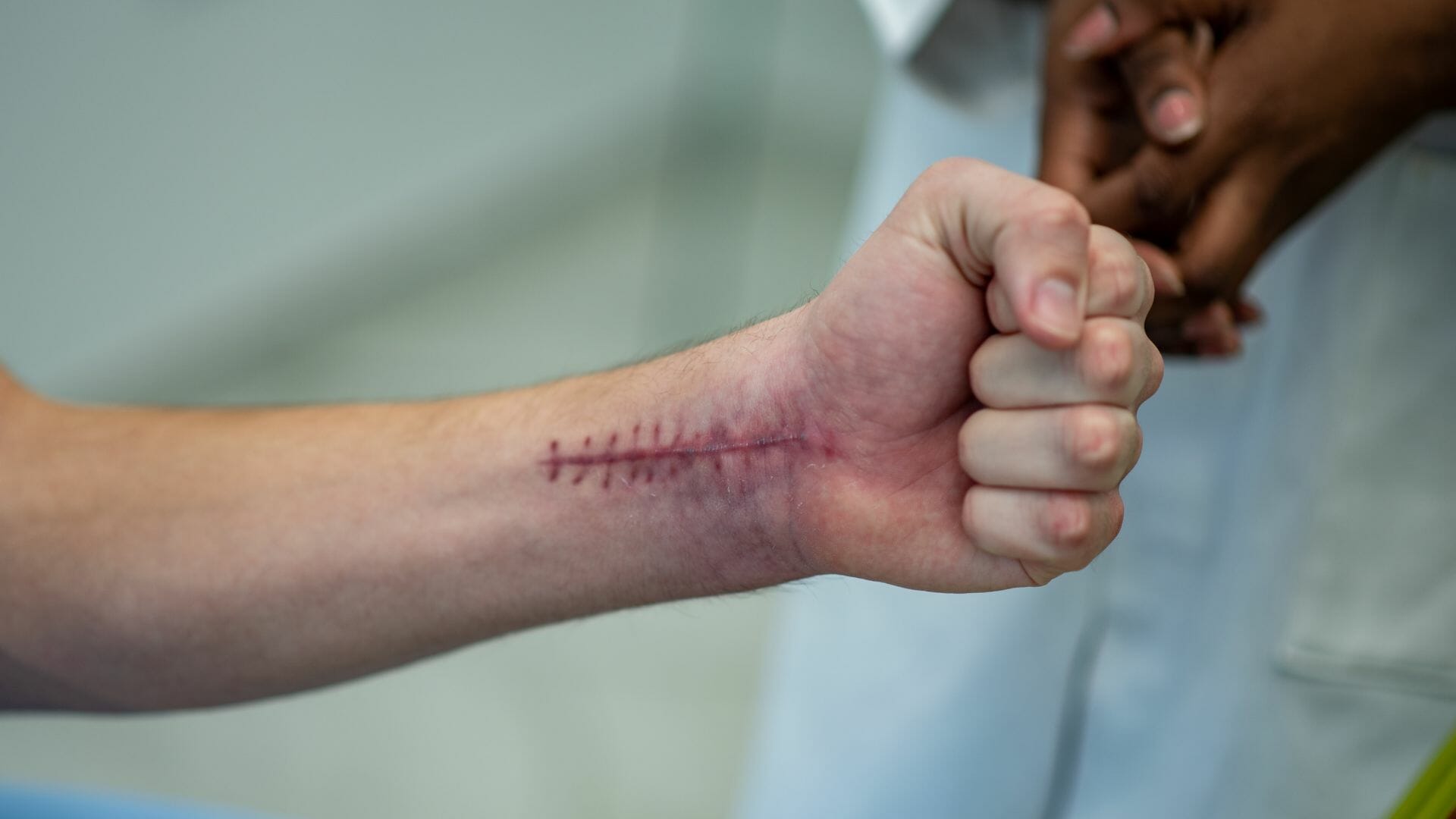 Compensation for Scar Injuries